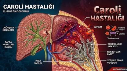 Caroli Hastalığı Nedir? Belirtileri, Nedenleri ve Tedavi Yöntemleri